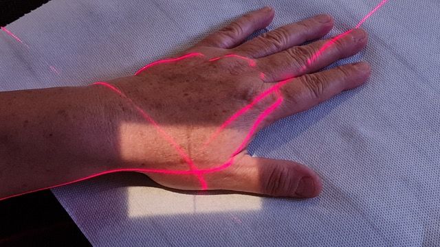 Aufnahme einer Hand bei der Orthovolt-Therapie. Die roten Bestrahlungslinien sind zu sehen.